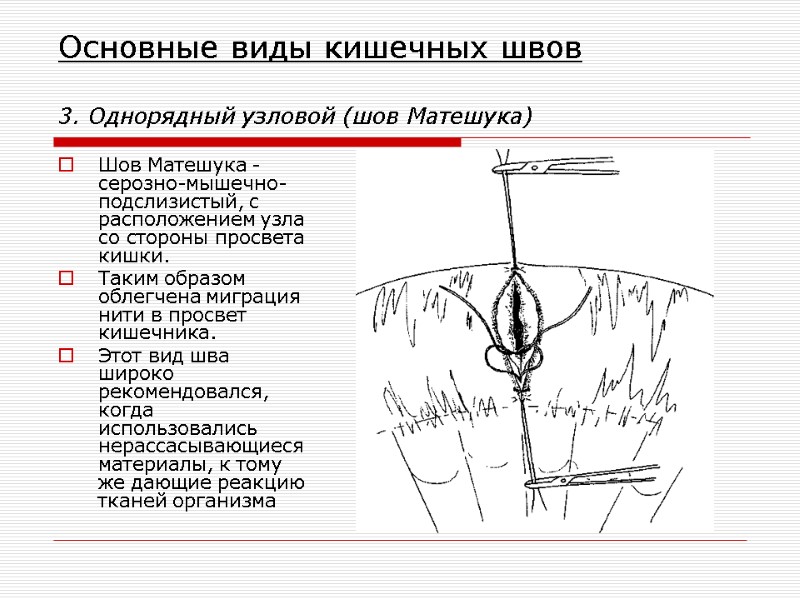 Основные виды кишечных швов  3. Однорядный узловой (шов Матешука) Шов Матешука - серозно-мышечно-подслизистый,